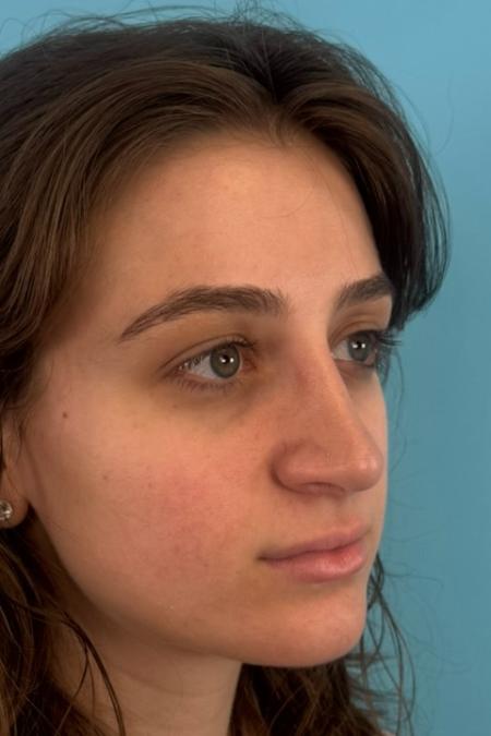 After image 4 Case #134751 - Rhinoplasty & Septoplasty - 1 year postop