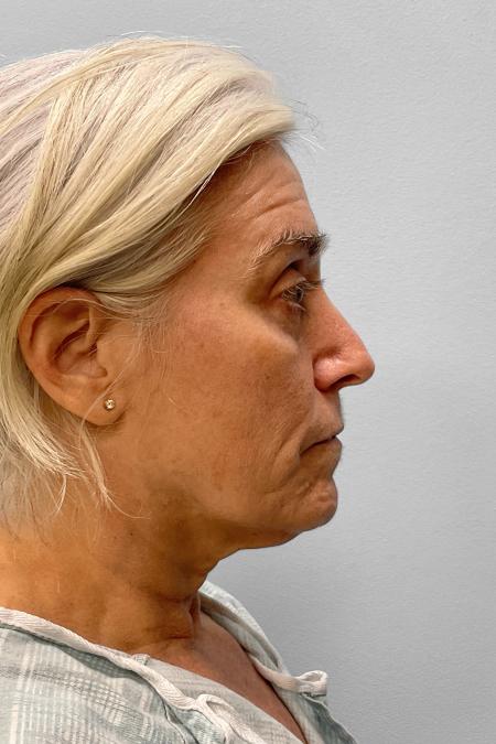 Before image 3 Case #134841 - Facial Rejuvenation