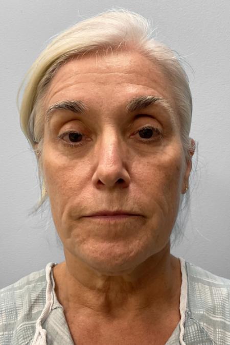 Before image 1 Case #134841 - Facial Rejuvenation