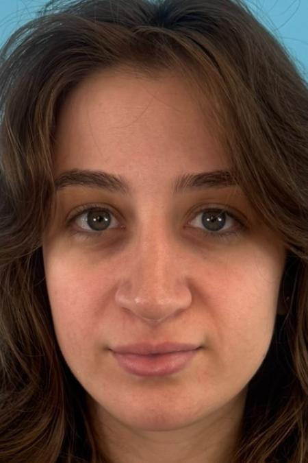 After image 1 Case #134751 - Rhinoplasty & Septoplasty - 1 year postop