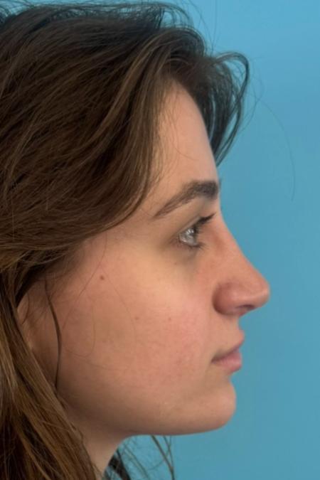 After image 5 Case #134751 - Rhinoplasty & Septoplasty - 1 year postop