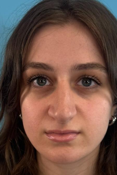 Before image 1 Case #134751 - Rhinoplasty & Septoplasty - 1 year postop