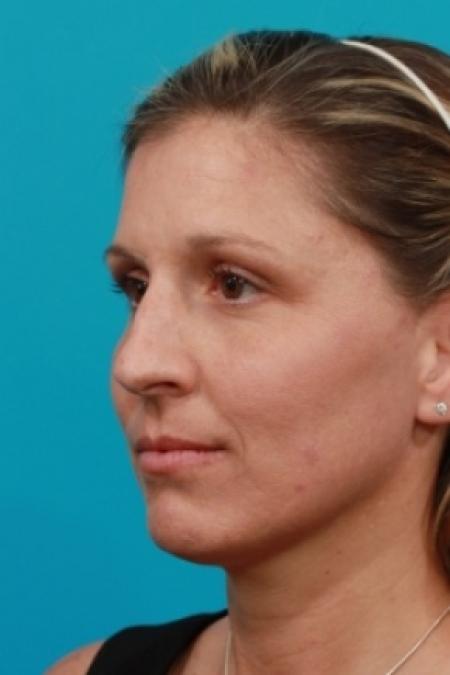 Before image 2 Case #80521 - Open Rhinoplasty