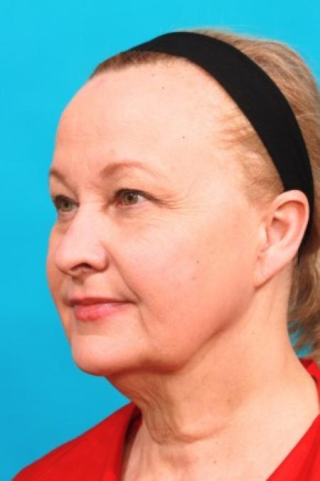 Before image 2 Case #85641 - Full Facial Rejuvenation