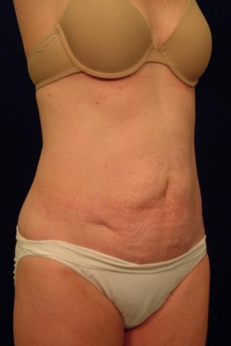 Before image 2 Case #87681 - Abdominoplasty