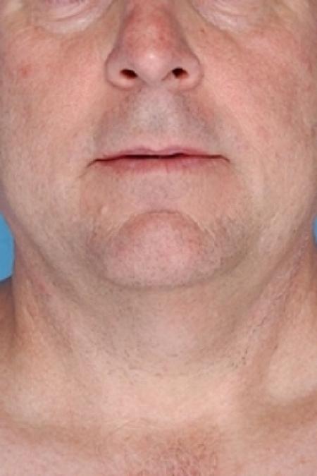 Before image 1 Case #79321 - Non-Surgical Focused Ultrasound