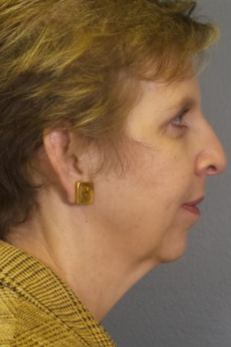 Before image 2 Case #83381 - Facelift with Chin Augmentation