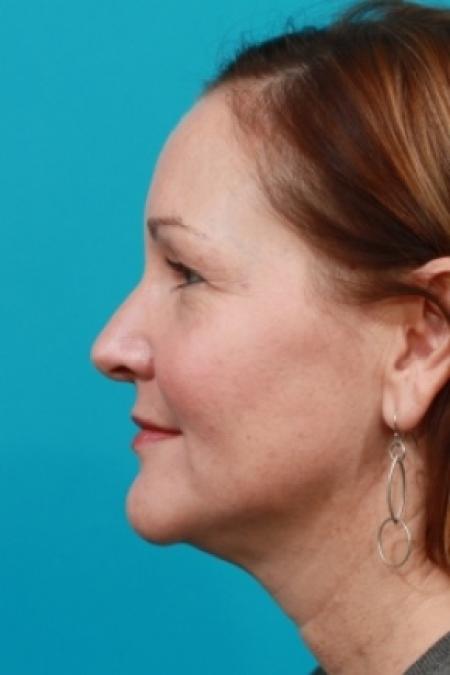 Before image 2 Case #78891 - Upper Blepharoplasty