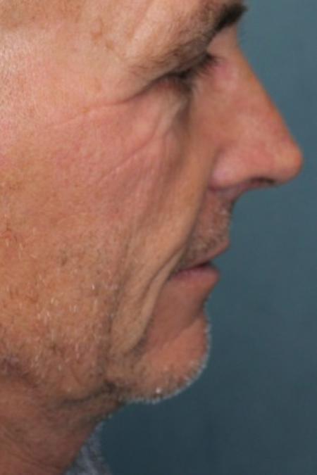 Before image 2 Case #87371 - Hair Transplantation San Diego