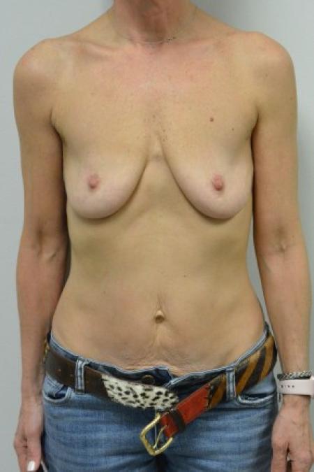 Before image 1 Case #88101 - 45-55 year woman treated with Ideal Structured Saline Implants