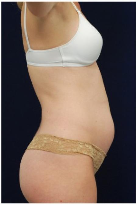 Before image 3 Case #82101 - Tummy Tuck