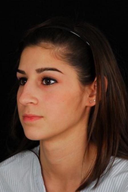 Before image 2 Case #81561 - Rhinoplasty