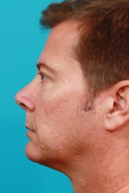 Before image 2 Case #78866 - Lower Blepharoplasty