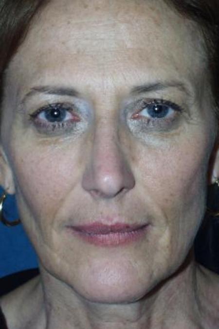 Before image 1 Case #80911 - Facelift