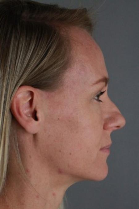 Before image 3 Case #87566 - Rhinoplasty