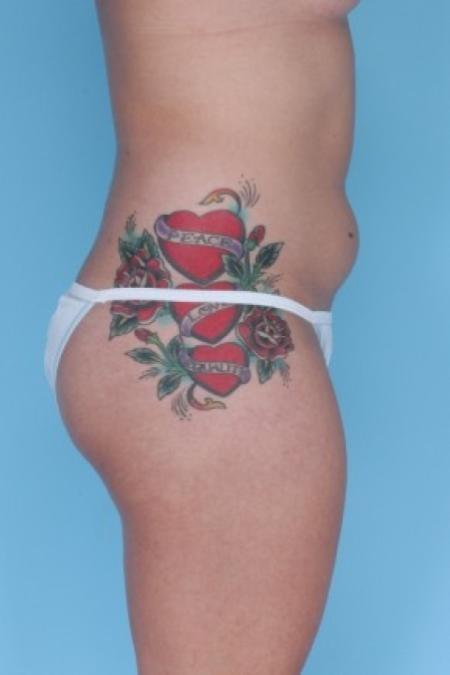 Before image 1 Case #82286 - Liposuction