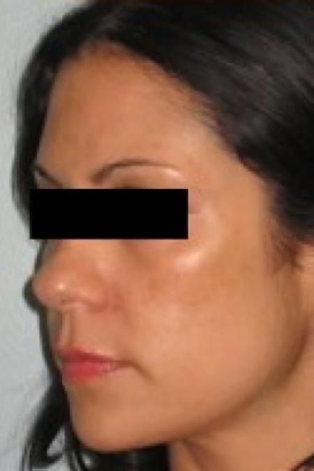 Before image 2 Case #85656 - Rhinoplasty 