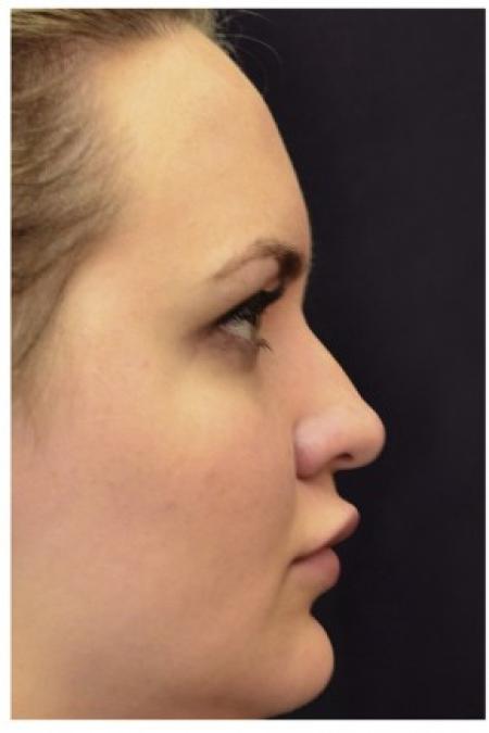 Before image 3 Case #86346 - 25 year old woman treated with nonsurgical rhinoplasty