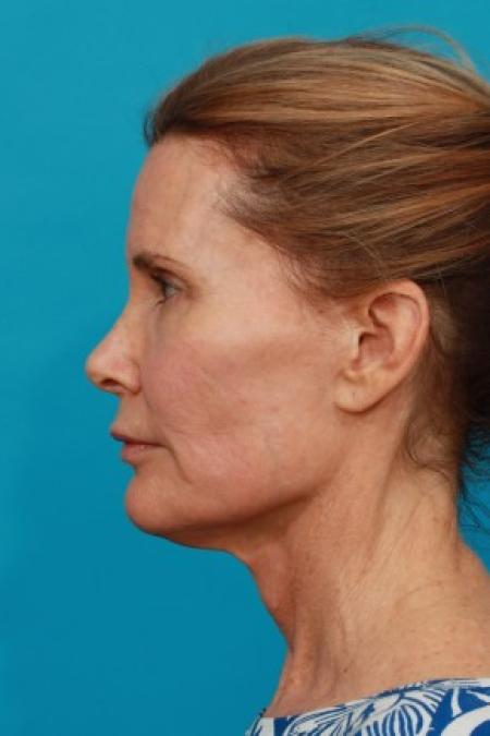 Before image 3 Case #84016 - Secondary Face / Neck Lift