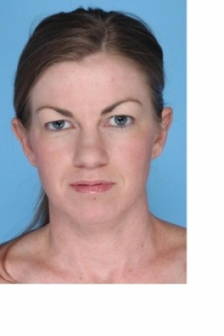 Before image 3 Case #80586 - Upper Blepharoplasty