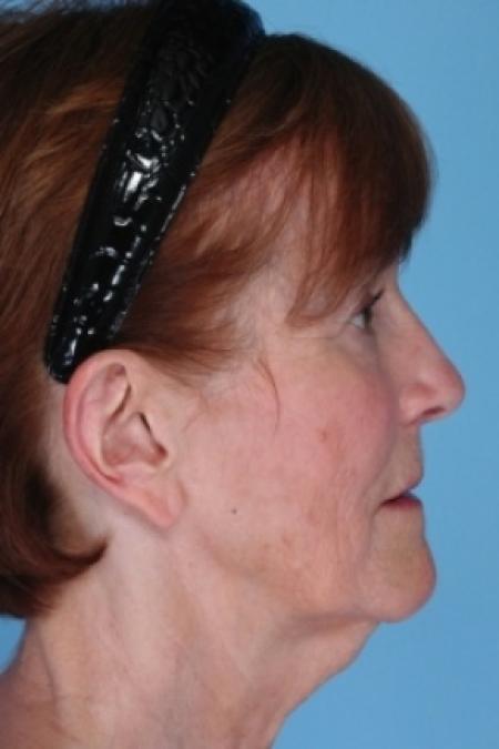 Before image 2 Case #80581 - Otoplasty with Earlobe Reduction