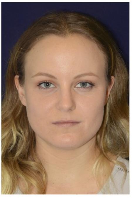 Before image 1 Case #86336 - 26 year old woman treated with fillers
