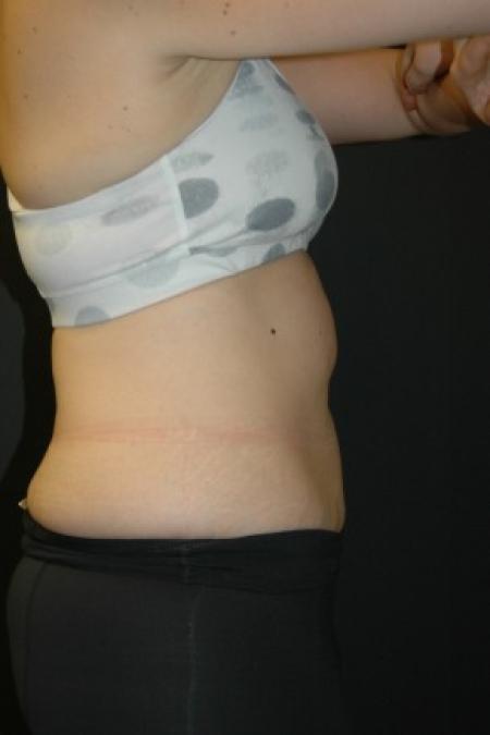 Before Case #81341 - Coolsculpting Procedure on Upper Abdomen