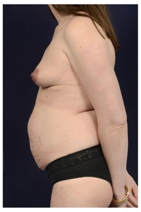 Before image 3 Case #85571 - Mommy Makeover