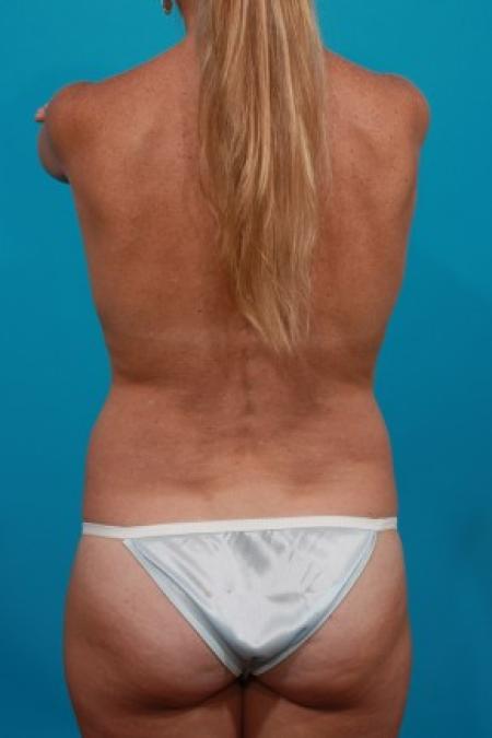 Before image 2 Case #84001 - Flank Liposuction