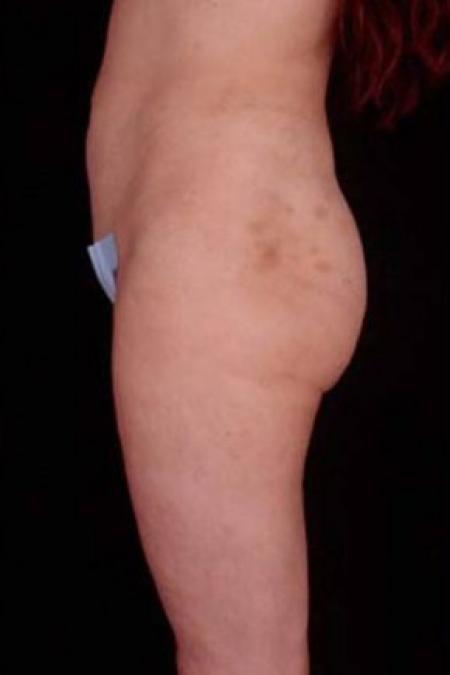 Before image 2 Case #81666 - Liposuction