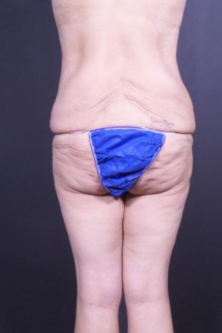 Before image 3 Case #84841 - Bodylift