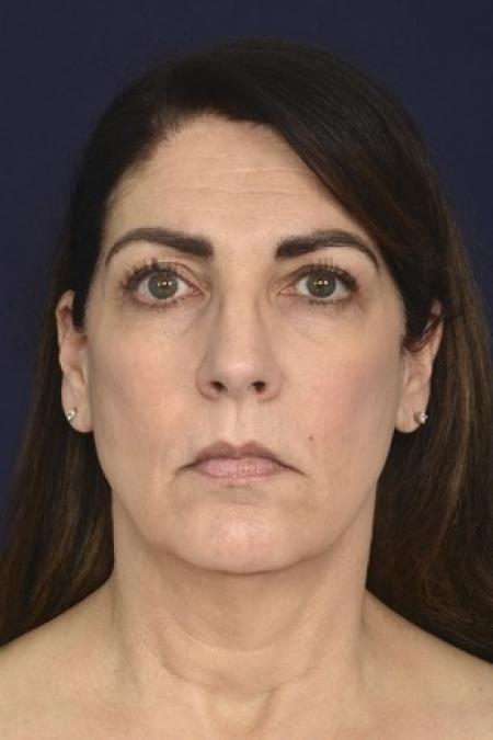 Before image 1 Case #87431 - Full Facial Rejuvenation