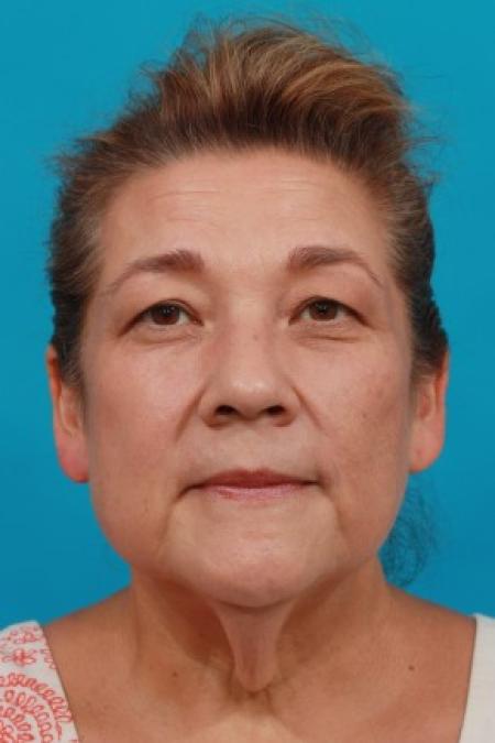 Before image 1 Case #85621 - Neck / Lower Face Lift