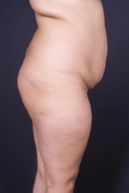 Before image 1 Case #85121 - Liposuction of the Abdomen and Hips with Fat Transfer to Buttocks