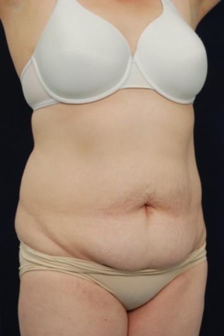 Before image 2 Case #87696 - Abdominoplasty