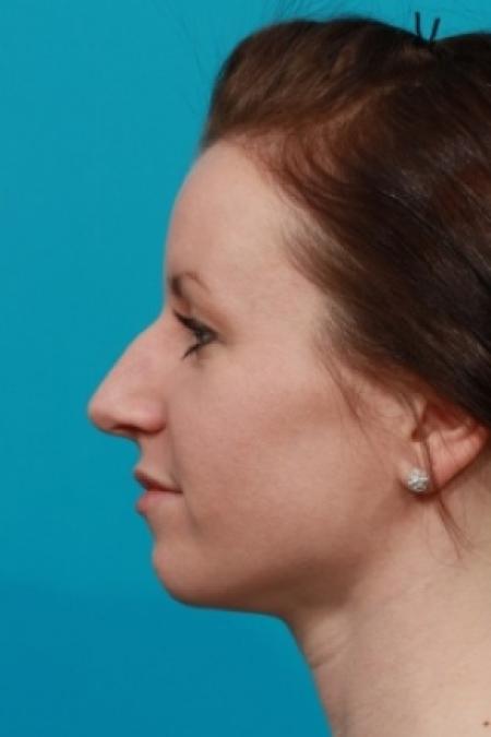 Before image 3 Case #78756 - Rhinoplasty (Nose Reshaping)