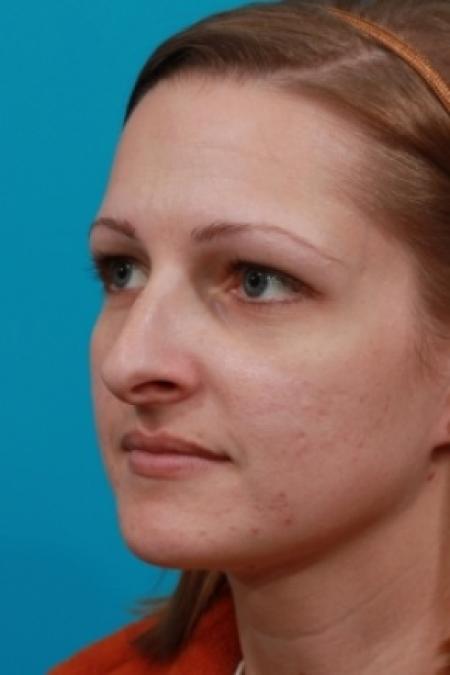 Before image 2 Case #78781 - Rhinoplasty (Nose Reshaping)