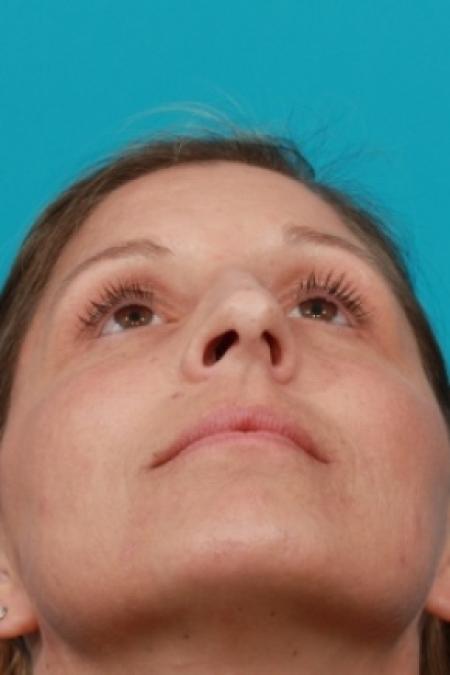 Before image 4 Case #80521 - Open Rhinoplasty