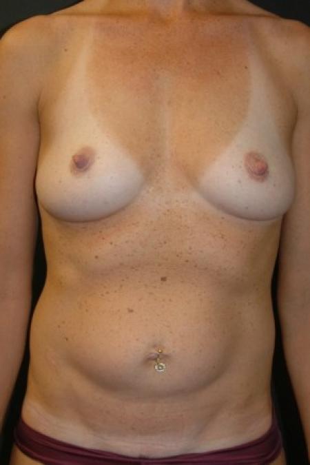 Before image 1 Case #81351 - "Mommy Make-Over" Breast Augmentation and Abdominoplasty using Allergan Style 410-FF535cc