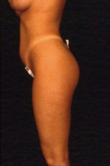 Before image 2 Case #81521 - Liposuction