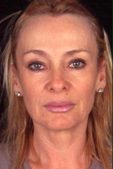 Before image 1 Case #81596 - Endoscopic Facelift