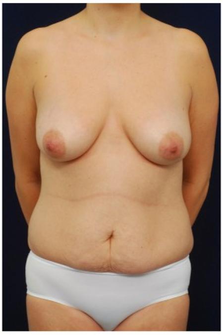 Before image 1 Case #82096 - Mommy Makeover