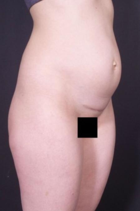Before image 2 Case #85826 - Abdominoplasty