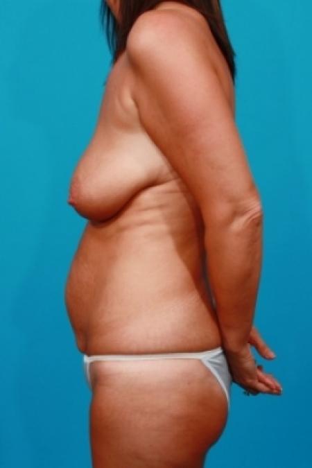 Before image 3 Case #78701 - Mommy Makeover