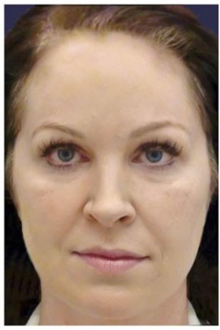 Before image 1 Case #86326 - 40 year old woman treated with Voluma