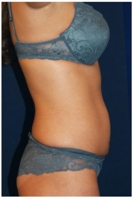 Before image 3 Case #82121 - Tummy Tuck