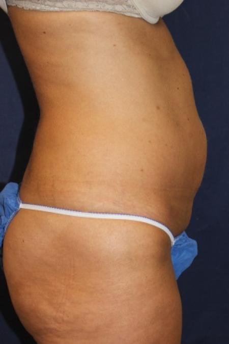 Before image 2 Case #80831 - Liposuction with "mini tummy-tuck"
