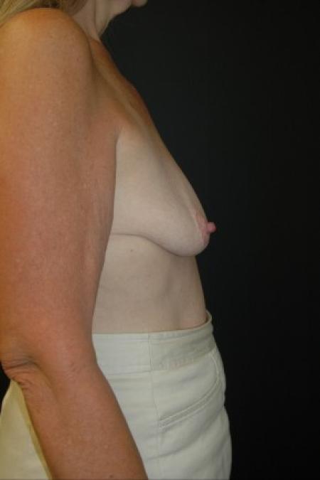 Before image 3 Case #81306 - Mastopexy with Breast Augmentation using Sientra MP-485cc