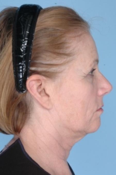 Before image 3 Case #80621 - Ulthera