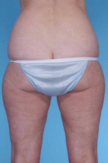 Before image 2 Case #82281 - Liposuction